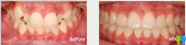 廈門(mén)峰煜牙齒擁擠不齊矯正案例