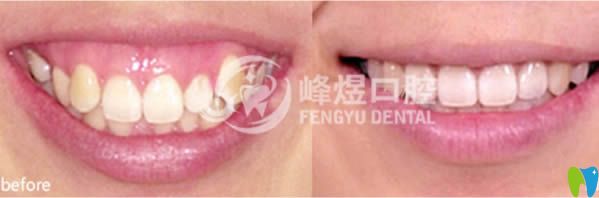 齙牙及虎牙矯正前后對(duì)比效果