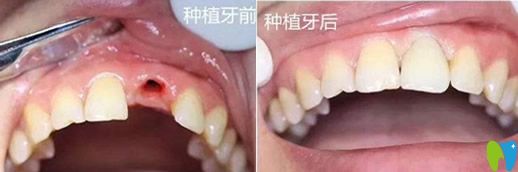 未來口腔歐陽秋單顆牙種植實(shí)例療效對比圖