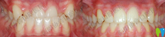 衡陽(yáng)協(xié)合口腔陽(yáng)望春院長(zhǎng)牙齒矯正前后對(duì)比圖