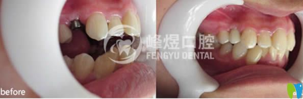 廈門(mén)峰煜口腔單顆牙缺失種植案例