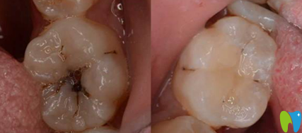 陳蔚蔚主任根管治療案例前后效果對比圖