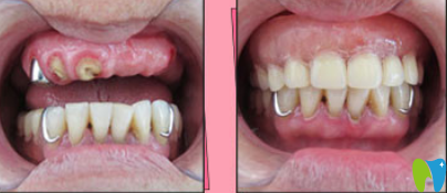 桂林瑾帆口腔李冉洲怎么樣呢？真人種植牙案例來驗(yàn)證