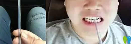 岳云鵬牙齒矯正圖