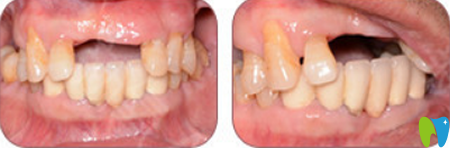 <!--<i data=20240703-sp></i>-->哪家種植牙好？來(lái)看<!--<i data=20240703-sp></i>-->伊爾意口腔種植牙案例