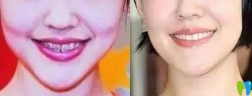美艷性感的小S就曾做過牙齒矯正