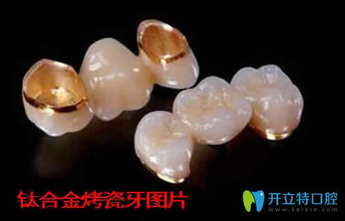 鈦合金烤瓷牙多少錢一顆  公布鈦合金烤瓷牙價(jià)格及使用壽命