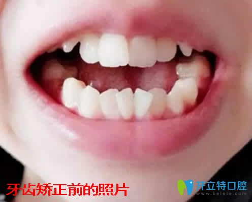 記錄我30歲在湛江致美口腔做自鎖陶瓷托槽矯正前后對(duì)照片