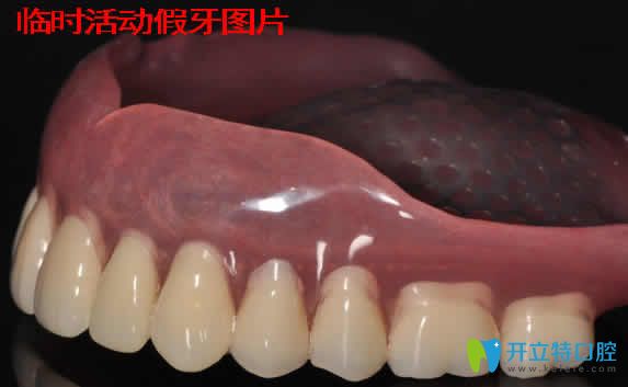 臨時活動假牙能戴多久？資深牙醫(yī)分享戴臨時假牙注意事項