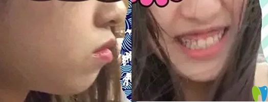 沒有去杭州美萊口腔做骨性齙牙前突矯正前樣子 沒有去杭州美萊口腔做骨性齙牙前突矯正前樣子
