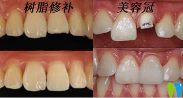 開立特口腔解答斷牙如何修復(fù)