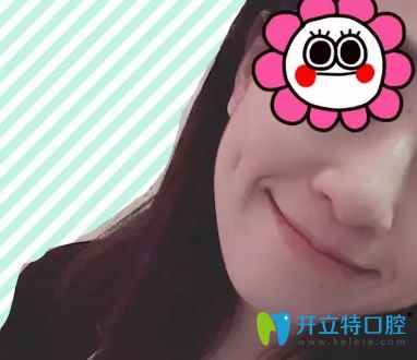 杭州美萊口腔骨性齙牙前突矯正變化照 杭州美萊口腔骨性齙牙前突矯正變化照