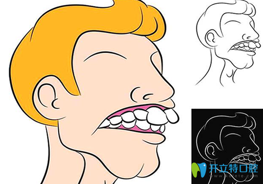 骨性齙牙通常伴有擁擠不齊，常與前牙深覆牙合