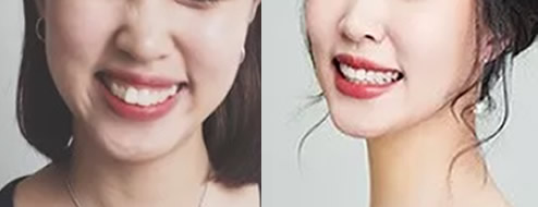 讓大家見證下我在重慶齊美口腔矯正齙牙、兔子牙511天變化