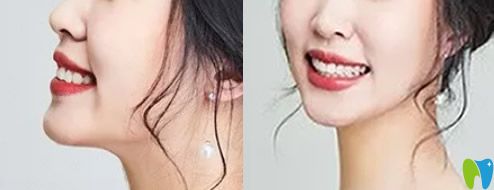 齊美口腔牙齒矯正17個月下牙套后照