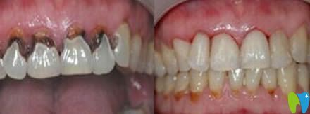 廈門亞歐齒科中心歐忠輝根管治療案例效果圖