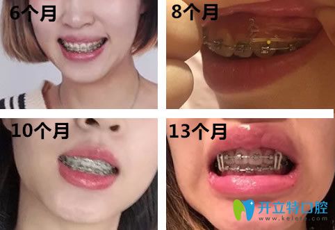 找重慶齊美口腔常書樓做牙齒矯正6~13個月變化圖片