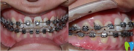 廈門亞歐齒科姚森院長(zhǎng)牙齒正畸案例