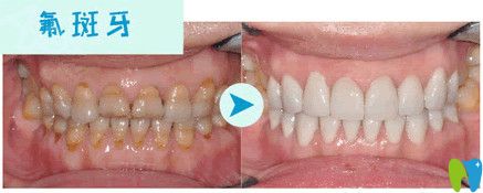 拉斐爾口腔瓷貼面后效果圖