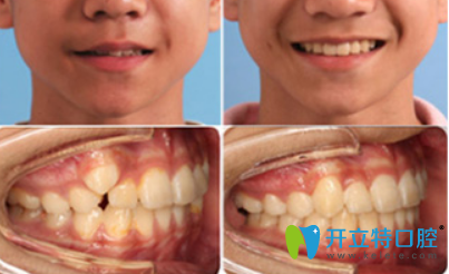 深圳河山齒科怎么樣？吳菊珍13歲少年虎牙矯正案例效果來證明