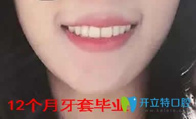 我在寧波拜博拜爾口腔做牙齒矯正1年取牙套后的照片