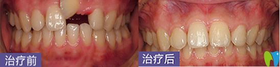 深圳烤瓷牙哪家好？鵬程口腔牙齒修復案例來嘍