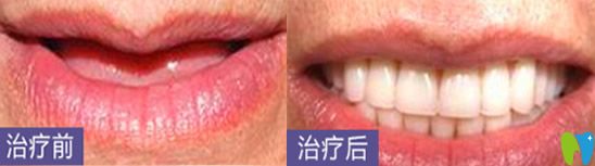 深圳哪家種植牙好？看深圳鵬程口腔種植牙案例