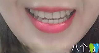 深圳鵬程口腔隱形矯正8個(gè)月效果圖