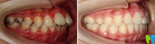 深圳河山齒科羅鵬飛怎么樣？羅鵬飛齙牙矯正案例效果來證明