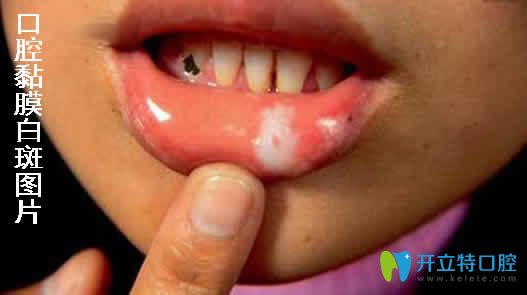 口腔黏膜白斑會(huì)自愈嗎？告訴你怎么治療及會(huì)不會(huì)癌變