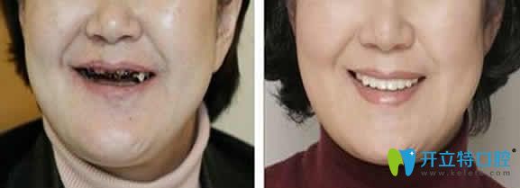 廈門宏沅膛口腔種植牙案例圖