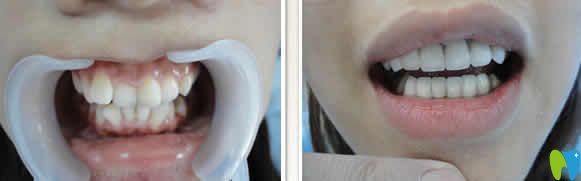 廈門宏沅膛口腔牙齒矯正前后對比圖