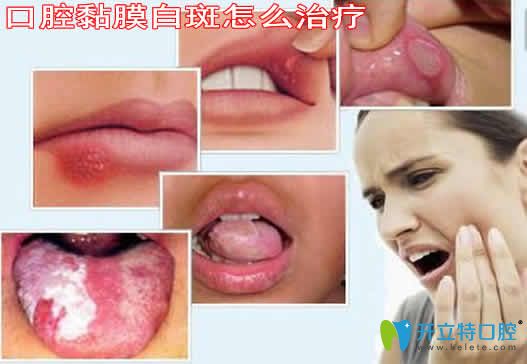 口腔黏膜白斑怎么治療