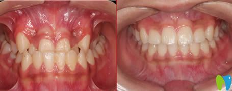 廈門亞歐齒科牙齒反合矯治效果圖
