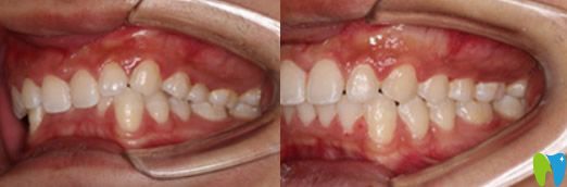 深圳河山齒科吳偉斌靠譜嗎？來(lái)看吳偉斌正畸案例