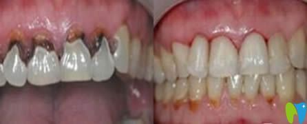 廈門亞歐齒科牙周治療效果圖