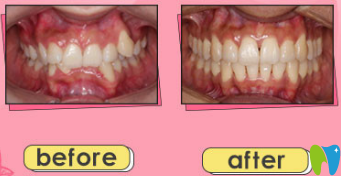 成都拉斐爾口腔黎佶醫(yī)生牙齒矯正前后對(duì)比圖