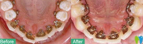 深圳牙齒正畸哪家好？鵬程口腔真人案例來驗證
