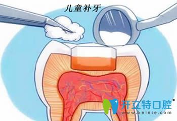 兒童補(bǔ)牙有必要嗎?另附小孩補(bǔ)牙價(jià)格和寶寶補(bǔ)牙過(guò)程圖解