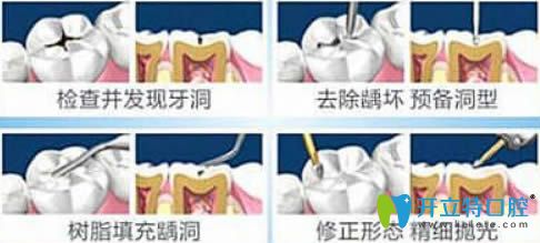 開(kāi)立特口腔網(wǎng)兒童補(bǔ)牙過(guò)程圖解