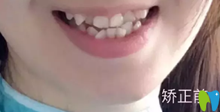 去深圳鵬程做牙齒矯正前