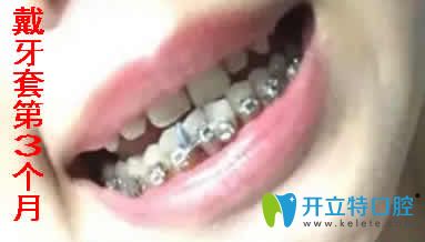 我在寧波拜博拜爾口腔做金屬自鎖托槽矯正第3個(gè)月照片