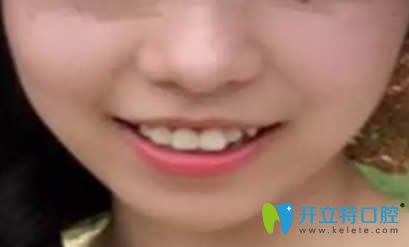 佩戴正雅隱形牙套3個月留照 佩戴正雅隱形牙套3個月留照