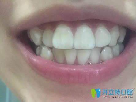 戴隱形牙套一周后的照片 戴隱形牙套一周后的照片