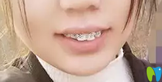 牙齒矯正3個月照片 牙齒矯正3個月照片