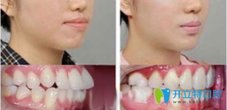 茂名致美齙牙矯正案例及臉型變化對比圖