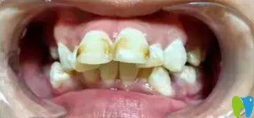 在拉斐爾口腔做矯正前照片 在拉斐爾口腔做矯正前照片