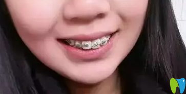 在拉斐爾口腔做牙齒矯正第6個月 在拉斐爾口腔做牙齒矯正第6個月