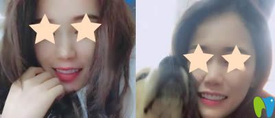 重慶眾植博仕口腔超薄牙貼面術(shù)后一月照 重慶眾植博仕口腔超薄牙貼面術(shù)后一月照