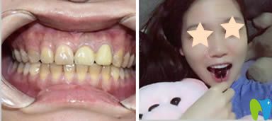 重慶眾植博仕口腔超薄瓷貼面效果對(duì)比圖 重慶眾植博仕口腔超薄瓷貼面效果對(duì)比圖